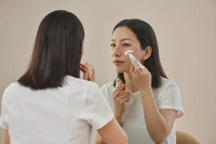 男生面部有濕疹不管它會(huì)自己痊愈嗎(圖3)