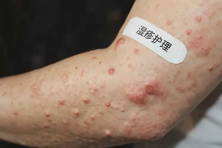 女生全身偶爾長(zhǎng)濕疹不管它會(huì)自己痊愈嗎(圖4)