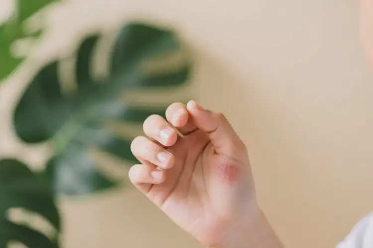 中學(xué)生身上經(jīng)常長(zhǎng)濕疹能靠自己自愈嗎(圖4)