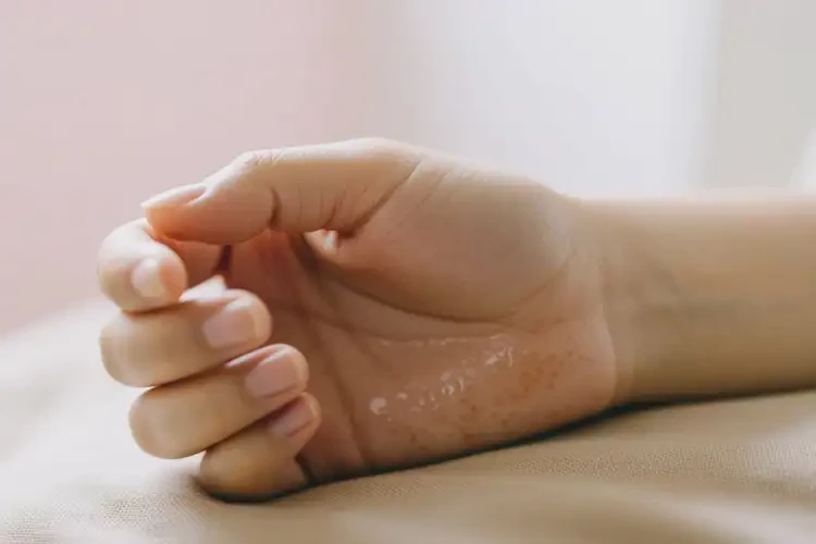 青年人手上容易起濕疹可以徹底自愈嗎(圖1)
