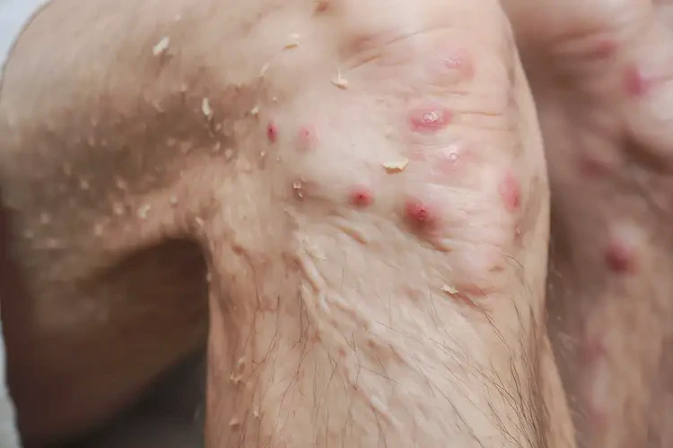 高齡老人大腿偶爾長(zhǎng)濕疹可不可以徹底自愈(圖4)