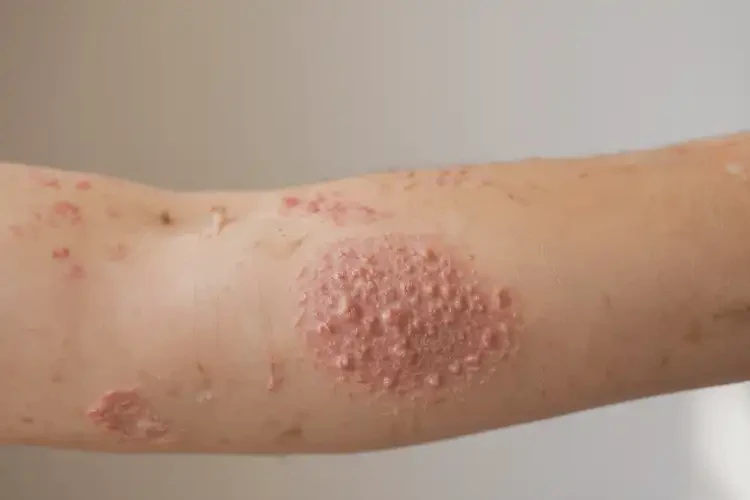 女生手臂容易長濕疹可不可以徹底自愈(圖3)