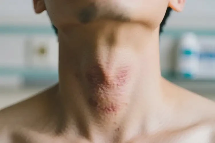 男人脖子上容易起濕疹可以徹底自愈嗎(圖3)
