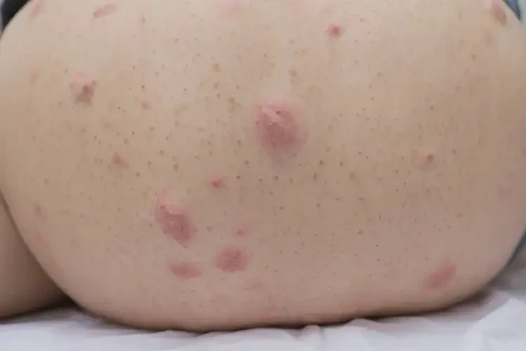 女生屁股上偶爾長(zhǎng)濕疹不管它會(huì)自己好嗎(圖2)