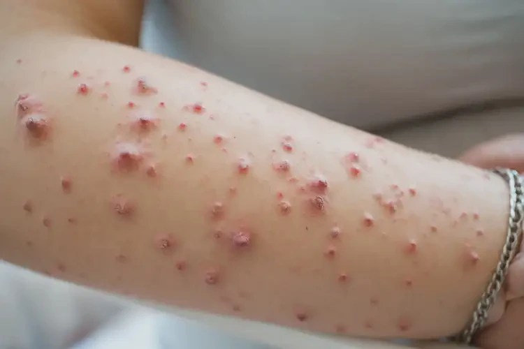 哺乳期媽媽手臂上長濕疹能不能根治(圖4)