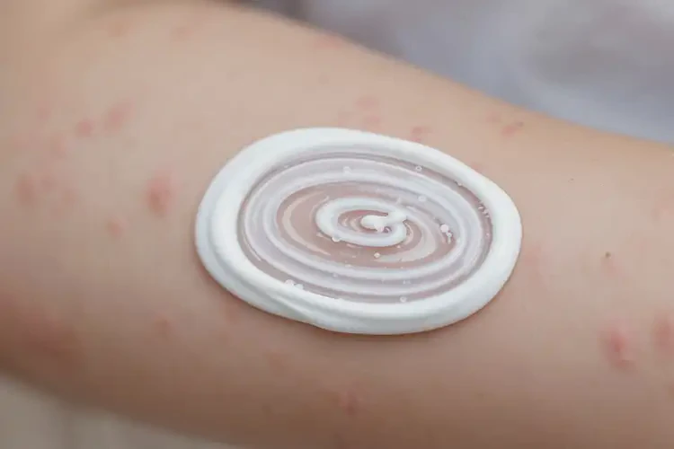 兒童手臂上出濕疹不管它會(huì)自己好嗎(圖3)