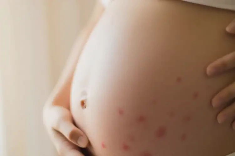 產(chǎn)婦肚子上經(jīng)常起濕疹能靠自己自愈嗎(圖3)