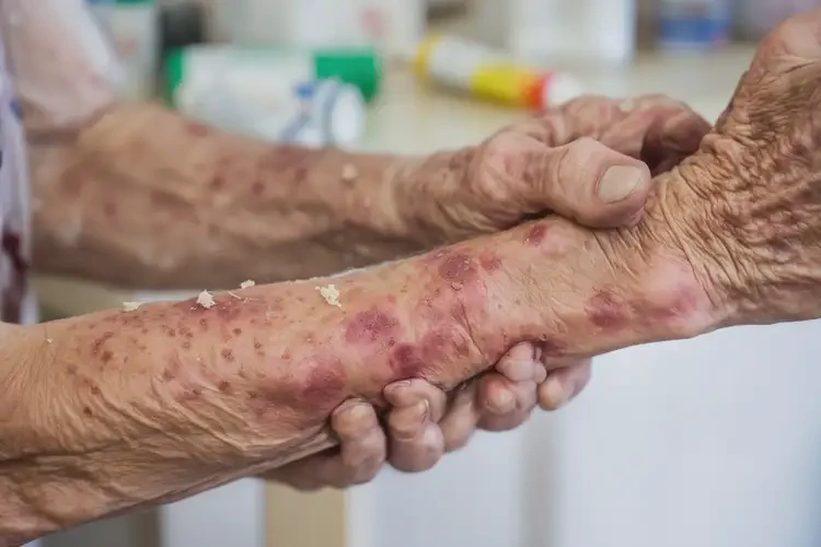 高齡老人身上出濕疹能不能根治(圖4)