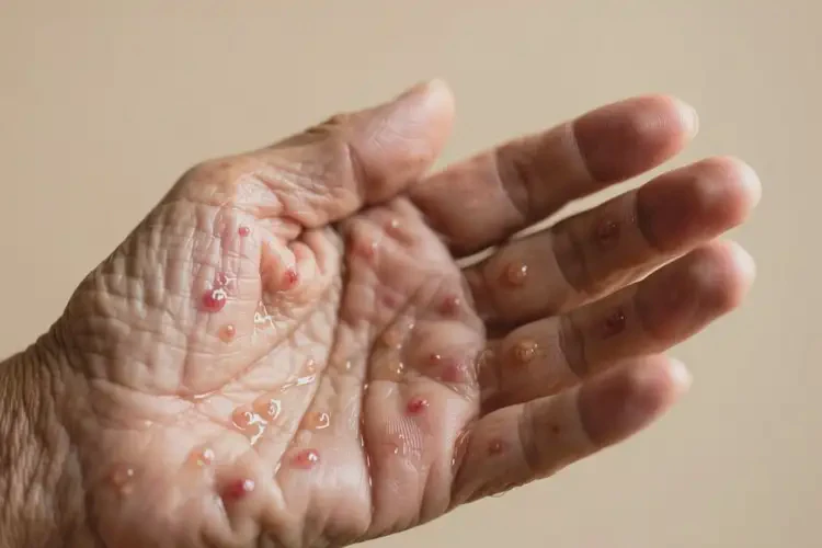 老年人手上起濕疹不管它會(huì)自己好嗎(圖3)
