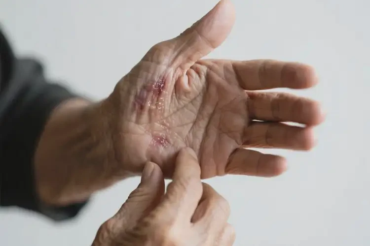 老人手臂上有濕疹不管它會(huì)自己自愈嗎(圖1)