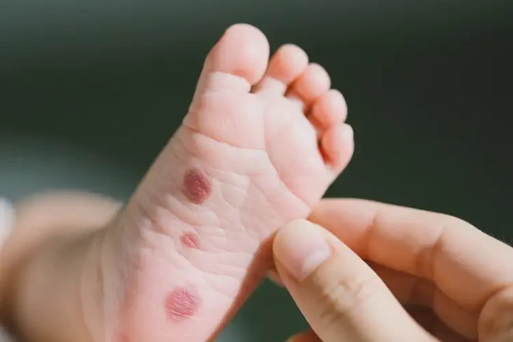 寶寶腳上起濕疹能徹底自愈嗎(圖2)