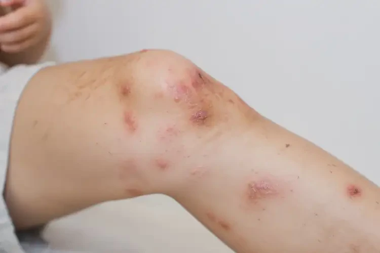 小兒大腿起濕疹能靠自己自愈嗎(圖4)