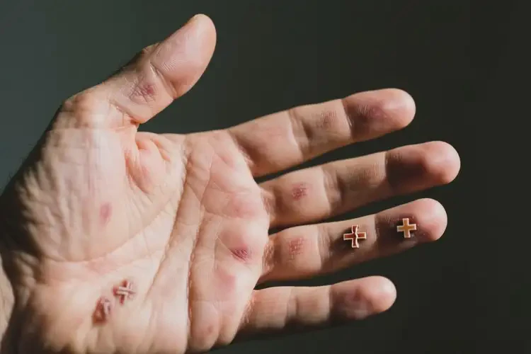 男人手上偶爾長(zhǎng)濕疹能不能根治(圖4)