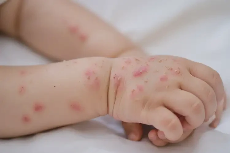 小孩手臂出濕疹可不可以徹底自愈(圖4)