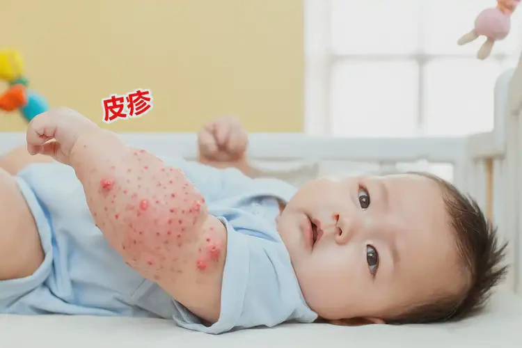 嬰兒手臂有濕疹可不可以根治(圖4)