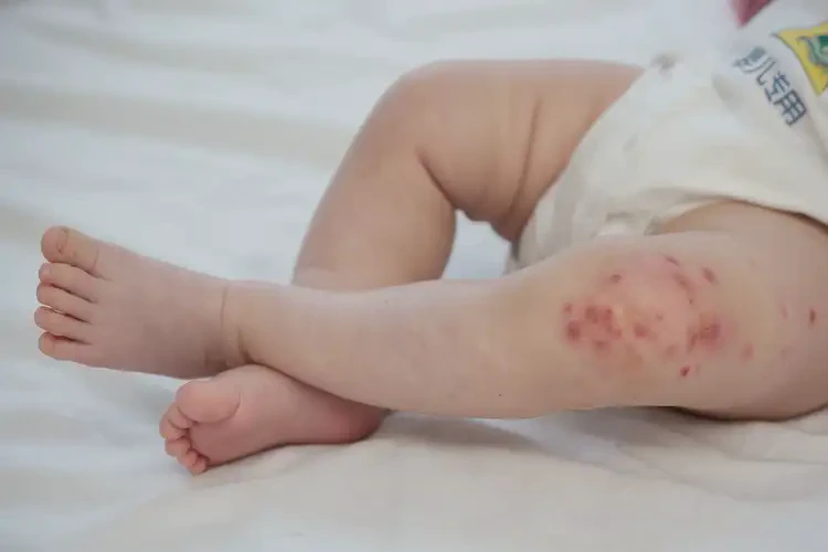 少兒大腿有濕疹不管它會自己好嗎(圖3)