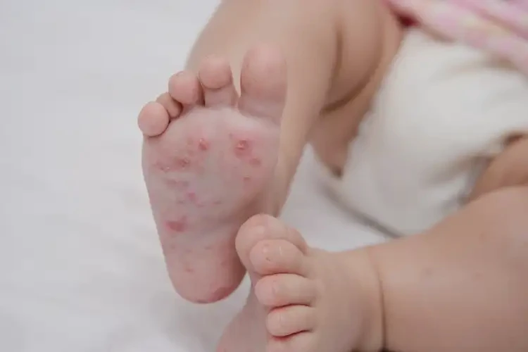 婴幼儿小腿偶尔起湿疹可不可以根治(图4)