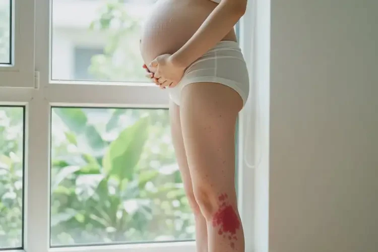 產(chǎn)婦小腿上起濕疹可以徹底自愈嗎(圖2)