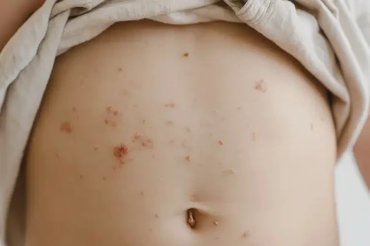 少儿肚子上容易长湿疹不管它会自己好吗(图4)