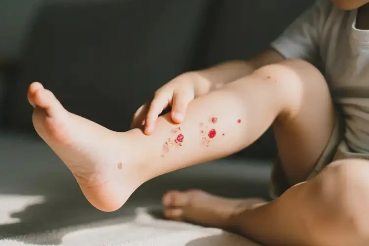 小孩小腿偶爾長(zhǎng)濕疹可不可以根治(圖2)