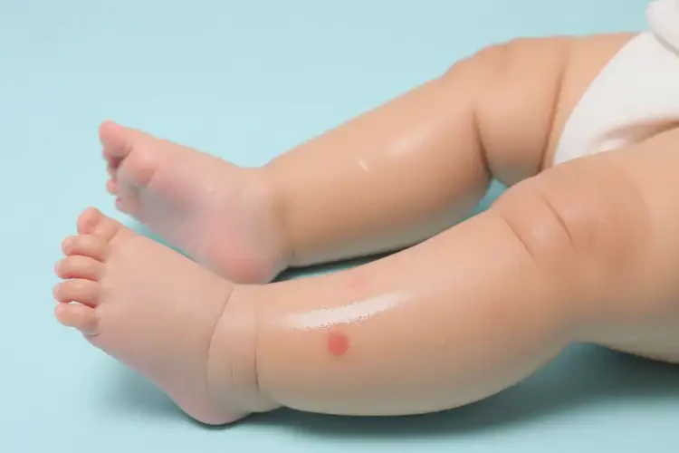 嬰幼兒小腿上偶爾長濕疹能徹底自愈嗎(圖1)