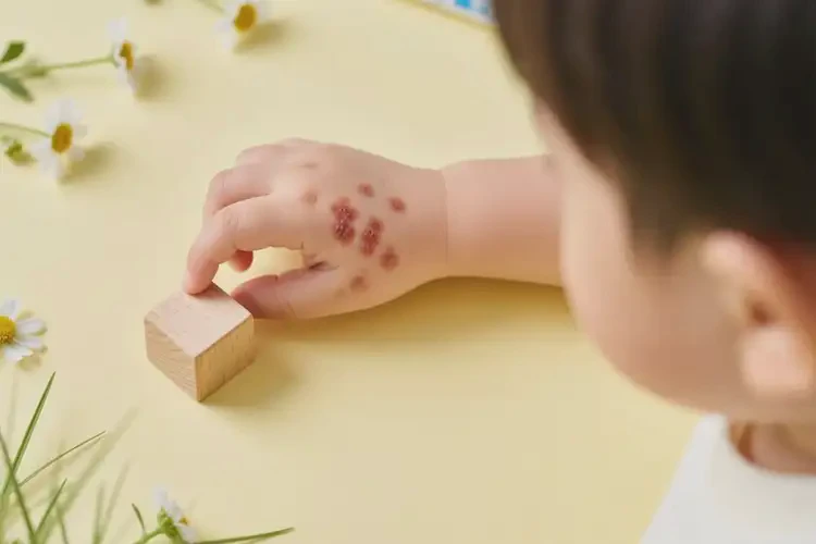 小兒手上出現(xiàn)濕疹不管它會自己自愈嗎(圖2)