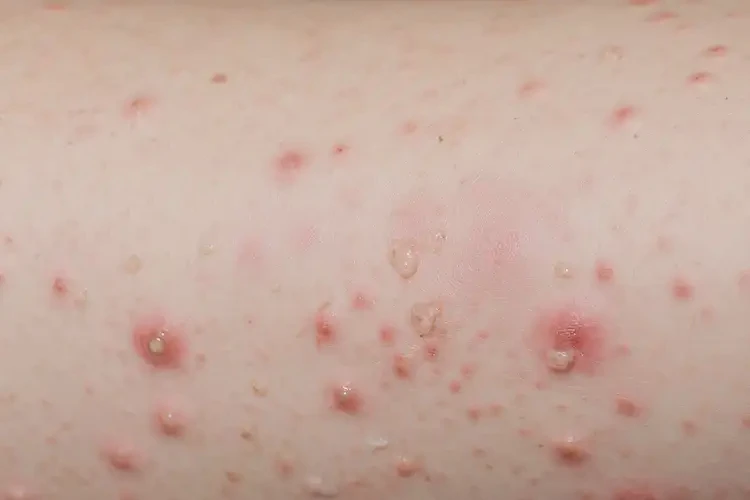 女性屁股上出現(xiàn)濕疹不管它會自己好嗎(圖3)