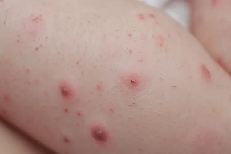 新生兒身上長濕疹可以徹底自愈嗎(圖4)