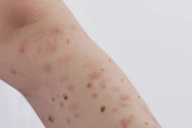 少儿四肢长湿疹能彻底自愈吗(图4)