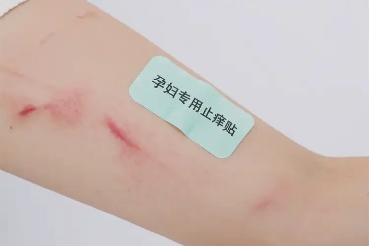 孕婦手臂上容易長濕疹不管它會自己自愈嗎(圖4)