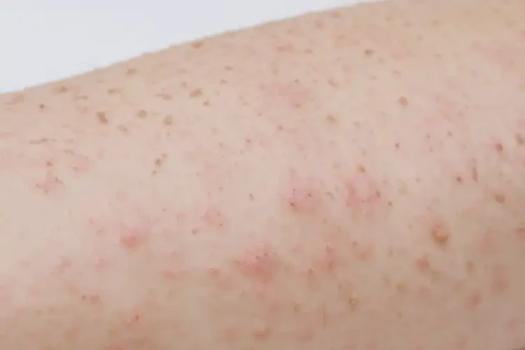 产妇手臂上偶尔长湿疹不管它会自己自愈吗(图4)