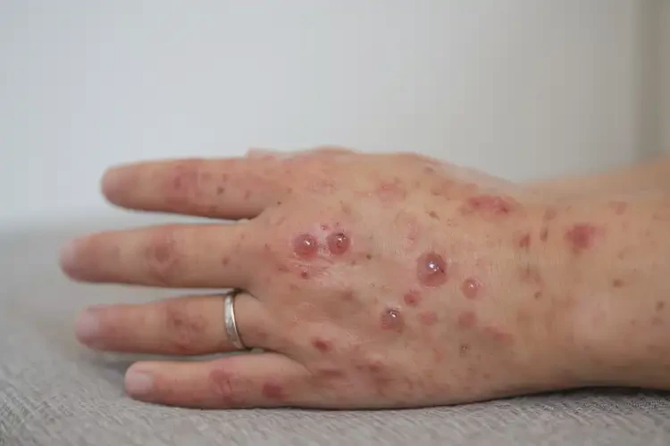 產(chǎn)婦手上偶爾長濕疹不管它會自己自愈嗎(圖3)