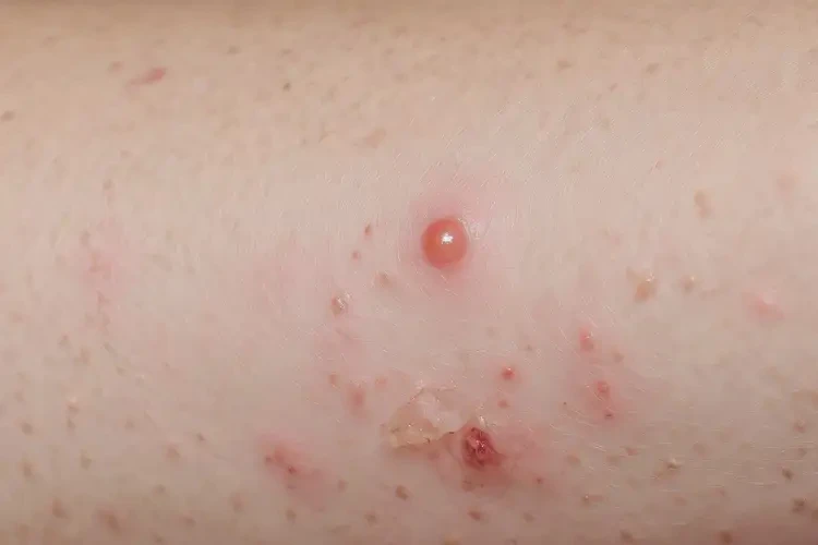 大學(xué)生小腿上出濕疹不管它會(huì)自己痊愈嗎(圖3)