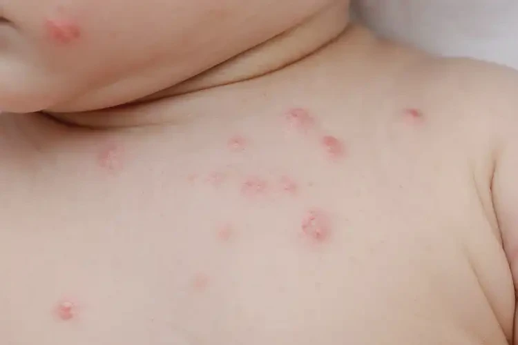 嬰幼兒脖子起濕疹可不可以根治(圖2)