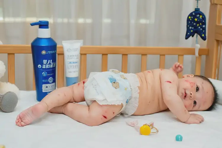 嬰幼兒屁股上有濕疹能靠自己自愈嗎(圖2)