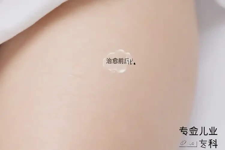 孩子大腿上有濕疹能夠徹底治愈嗎(圖4)