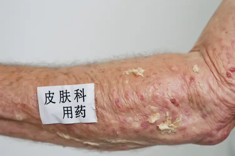 老年人四肢经常起湿疹不管它会自己痊愈吗(图4)