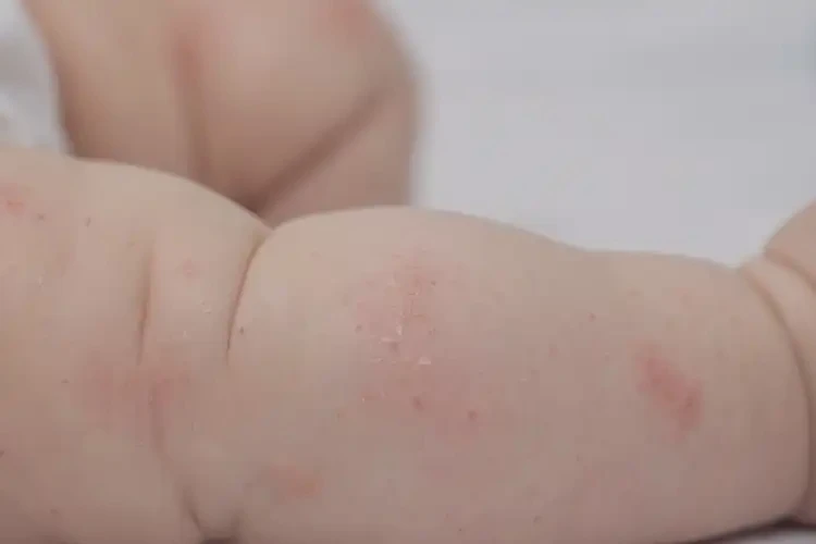 婴幼儿四肢偶尔起湿疹不管它会自己痊愈吗(图4)
