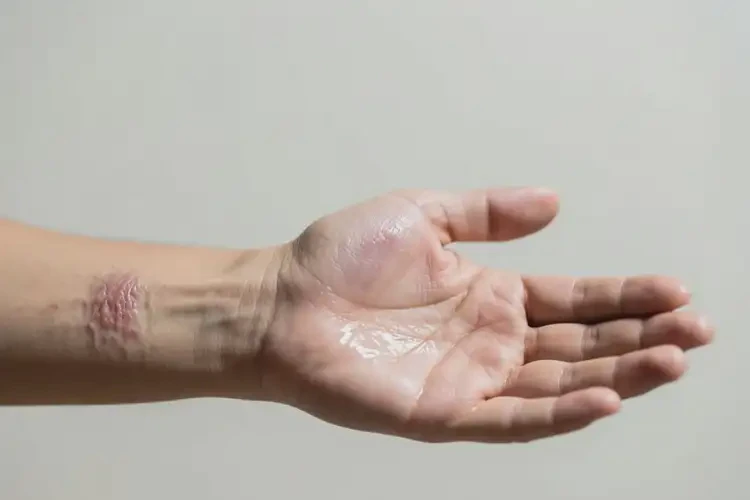 男人手臂上經(jīng)常長(zhǎng)濕疹能不能根治(圖1)