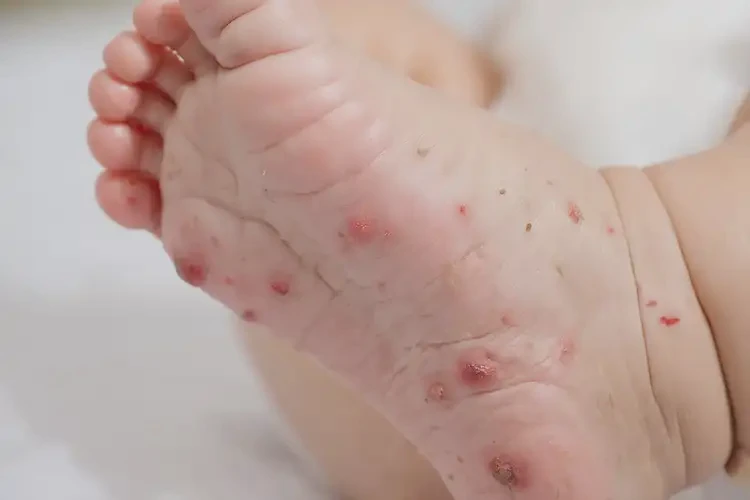 宝宝脚上容易起湿疹可不可以彻底自愈(图4)