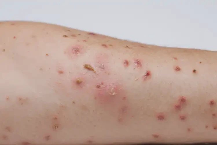 女性全身出現(xiàn)濕疹不管它會(huì)自己好嗎(圖4)