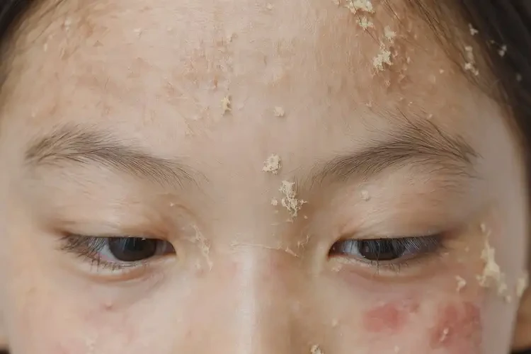 中學生肛周起濕疹不管它會自己痊愈嗎(圖3)