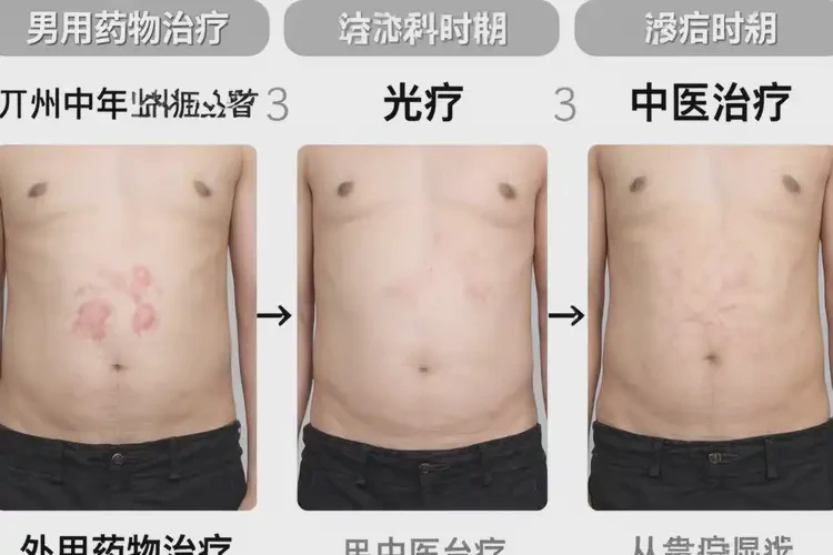 男人肚子容易長(zhǎng)濕疹能不能根治(圖3)