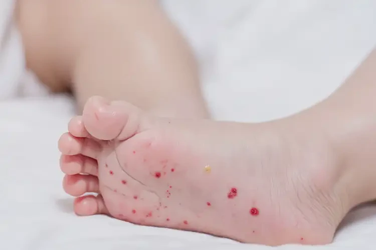 嬰兒腳上容易長(zhǎng)濕疹可不可以徹底自愈(圖3)