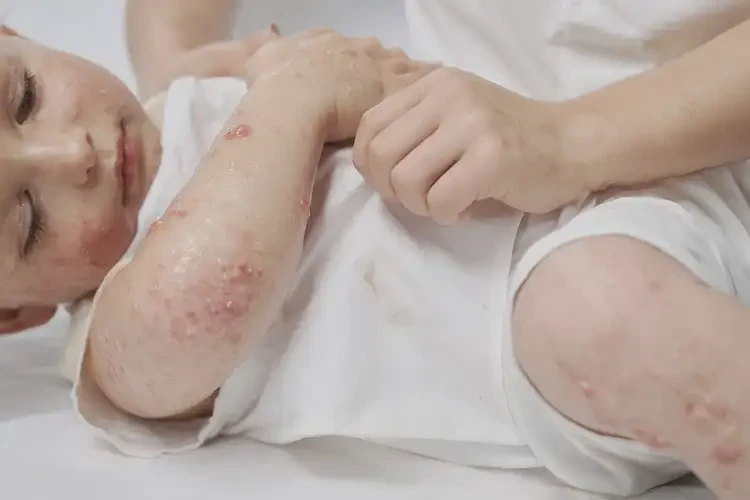 兒童大腿經(jīng)常起濕疹可不可以根治(圖4)