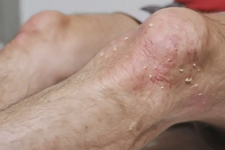 高齡老人大腿起濕疹能徹底自愈嗎(圖4)