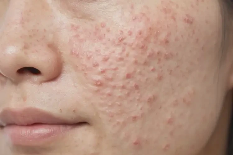 女生屁股上經(jīng)常起濕疹不管它會自己痊愈嗎(圖4)