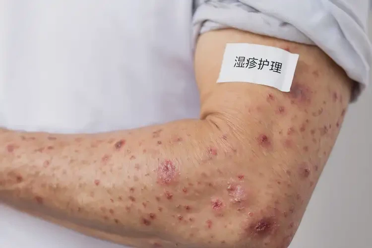 男性手臂经常起湿疹能靠自己自愈吗(图4)