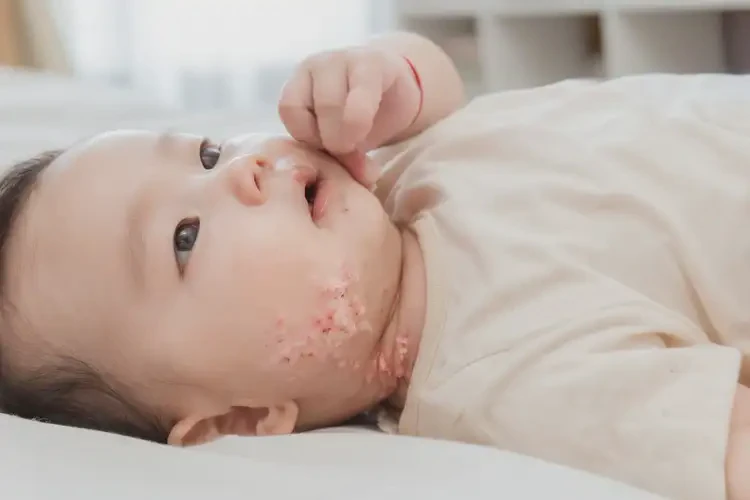 孩子脖子起濕疹可不可以徹底自愈(圖3)