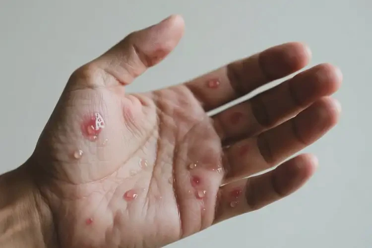 男人手上偶爾起濕疹不管它會自己好嗎(圖3)